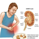 تصویر پکیج رفع سنگ کلیه گیاهی